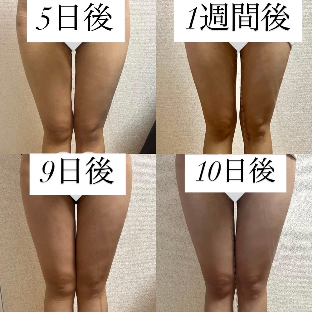症例ダウンタイム-08（復元・旧HP）
