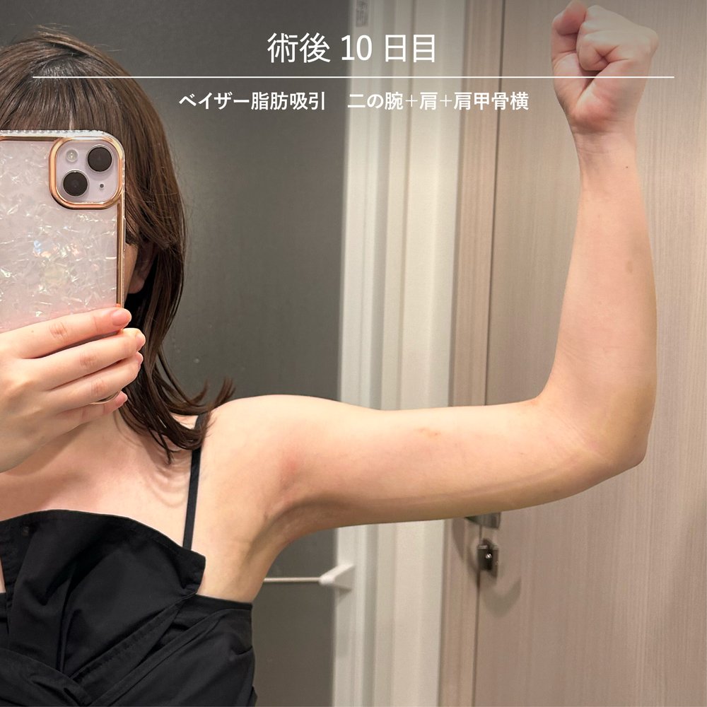 ダウンタイム経過_二の腕-13（復元・旧HP）