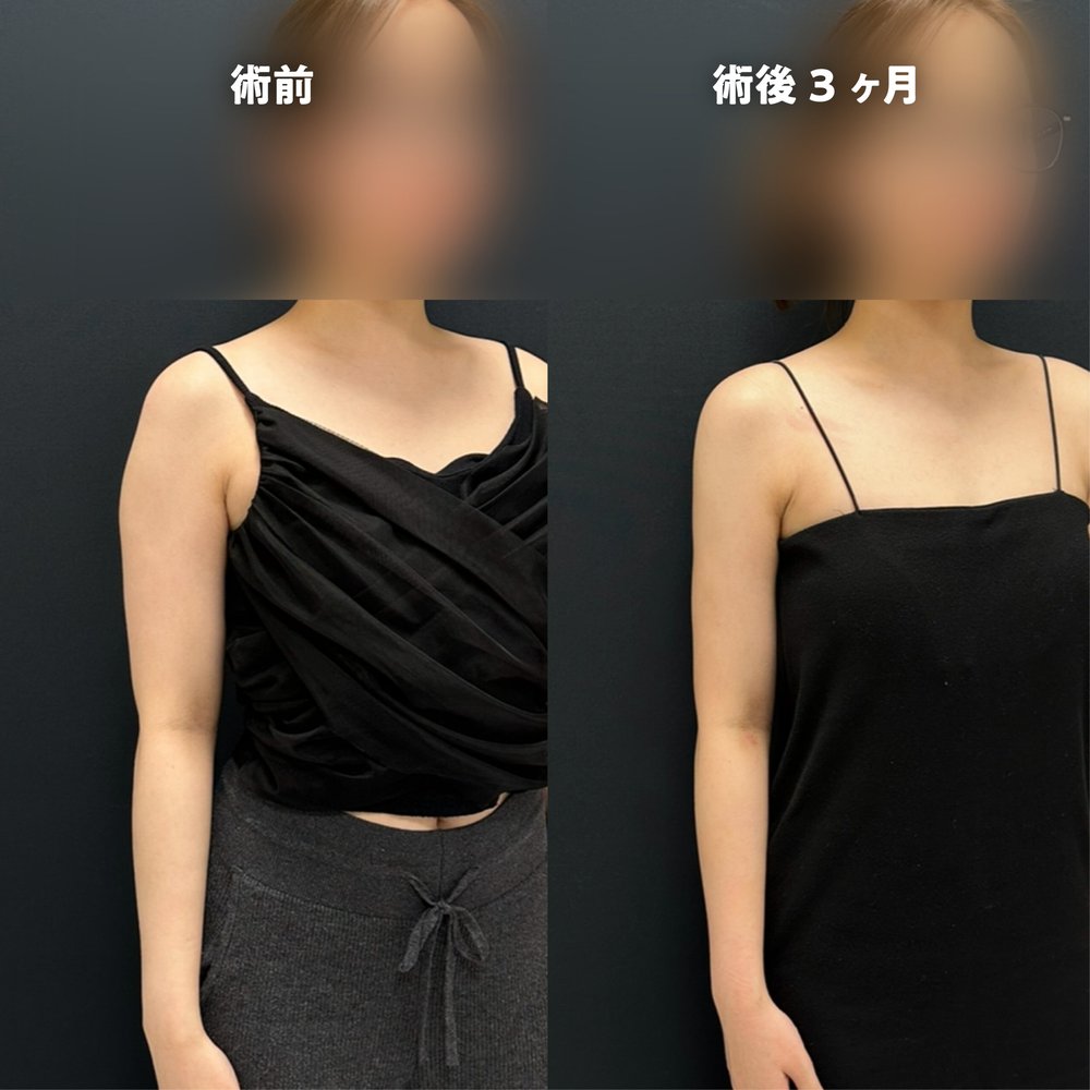 ダウンタイム経過_二の腕_2-23（復元・旧HP）