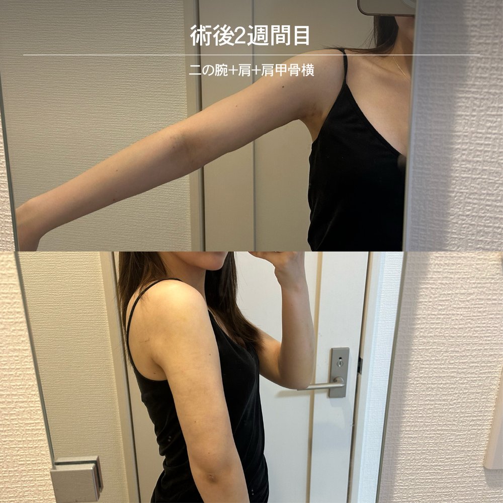 ダウンタイム経過_二の腕_2-20（復元・旧HP）