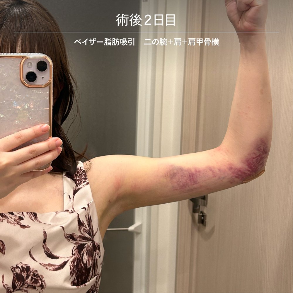 ダウンタイム経過_二の腕-09（復元・旧HP）