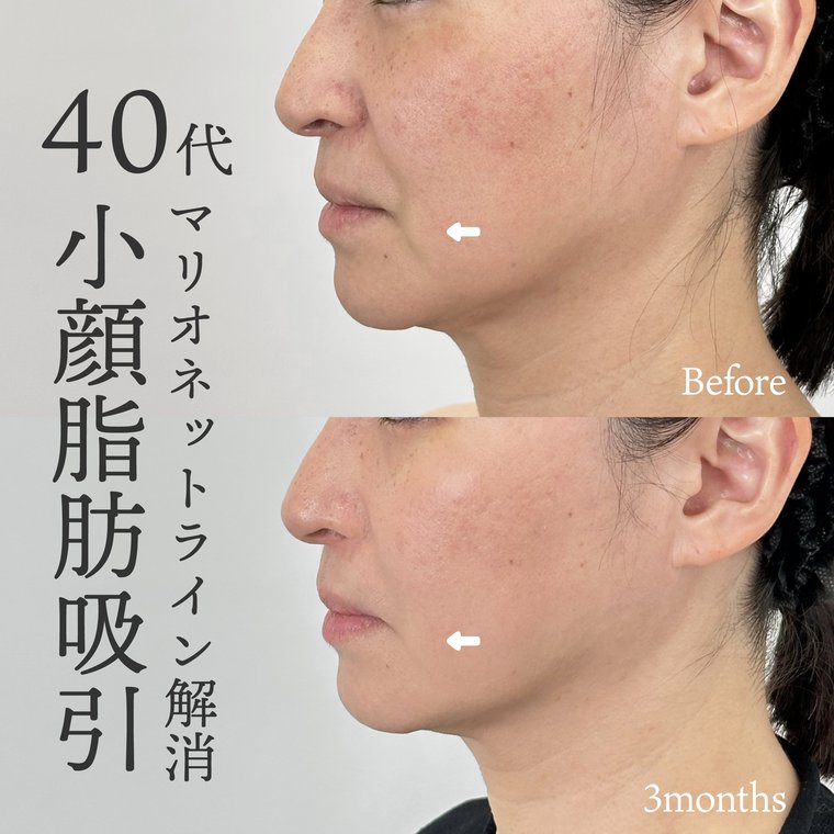 40代女性　ジョールファット除去