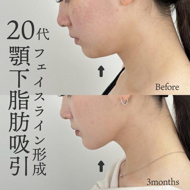 20代女性　顎下脂肪吸引
